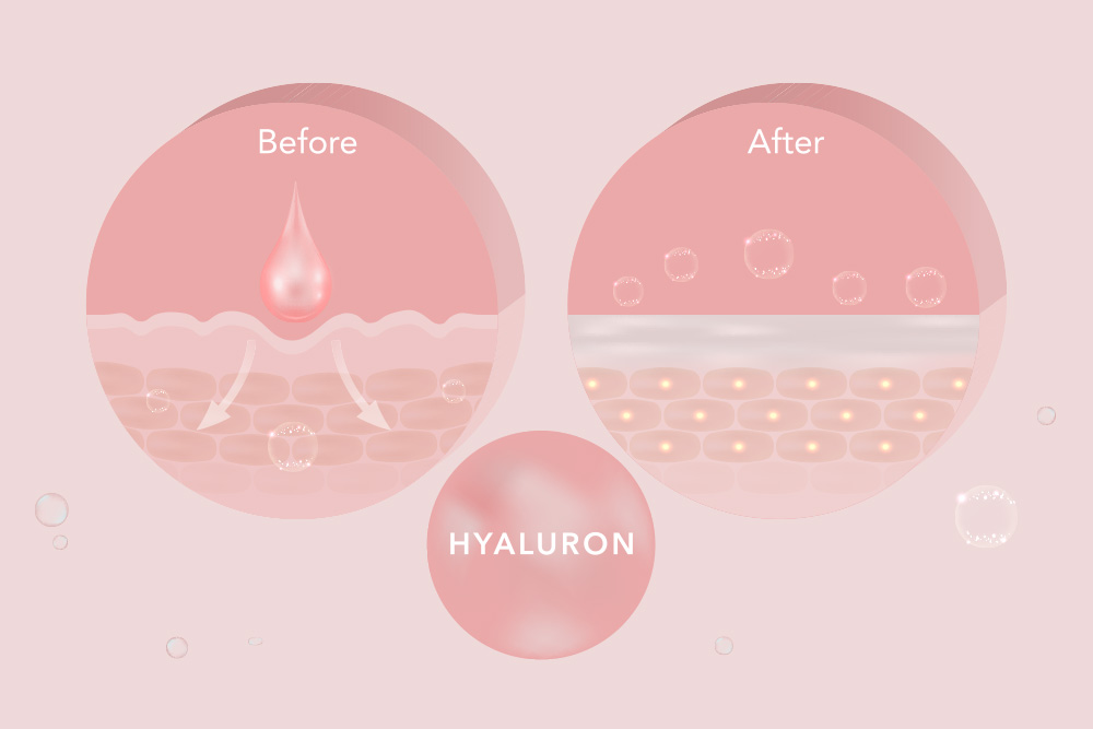 Hyaluronic Acid Fillers